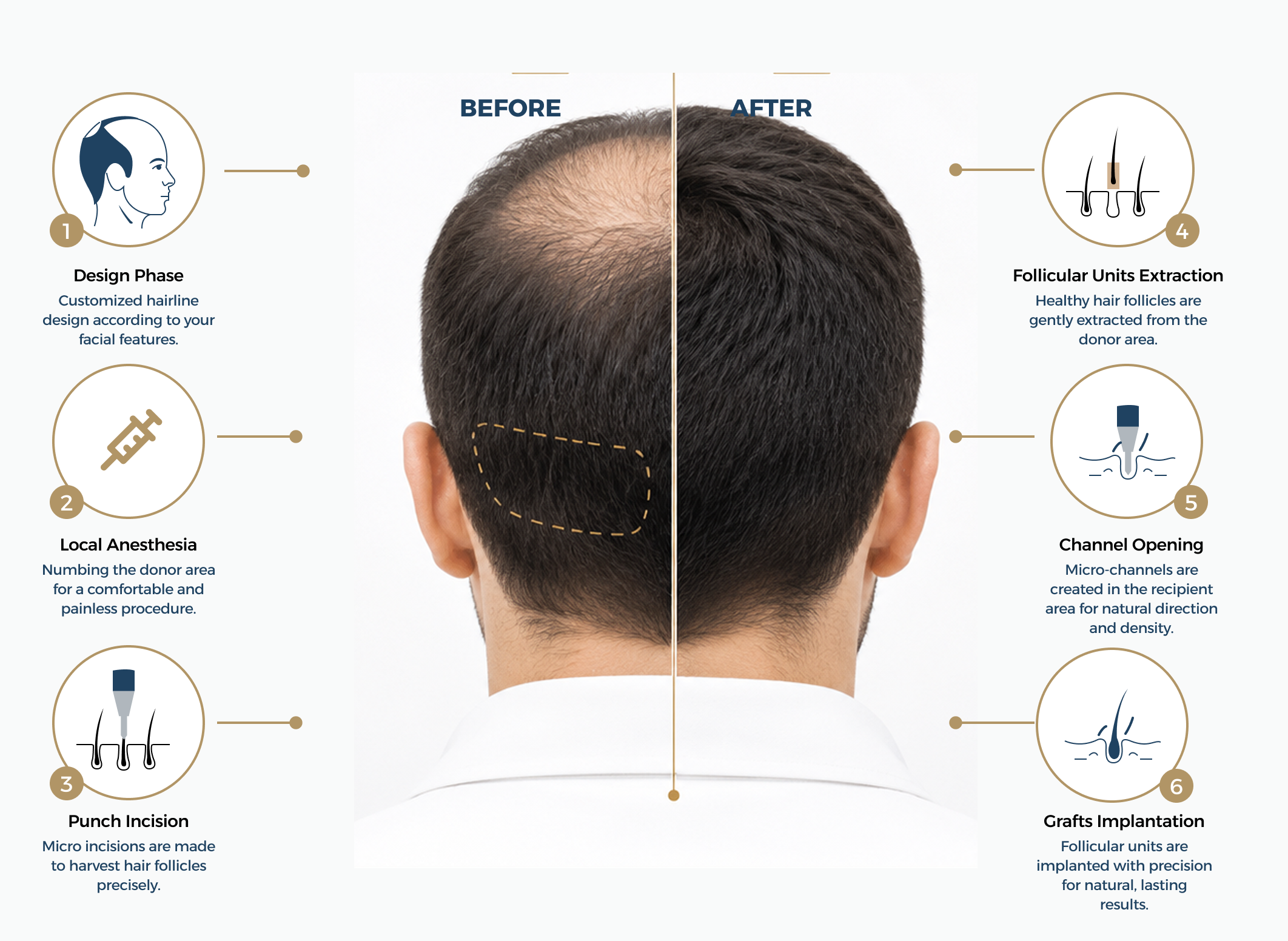 Stages of Hair Transplantation